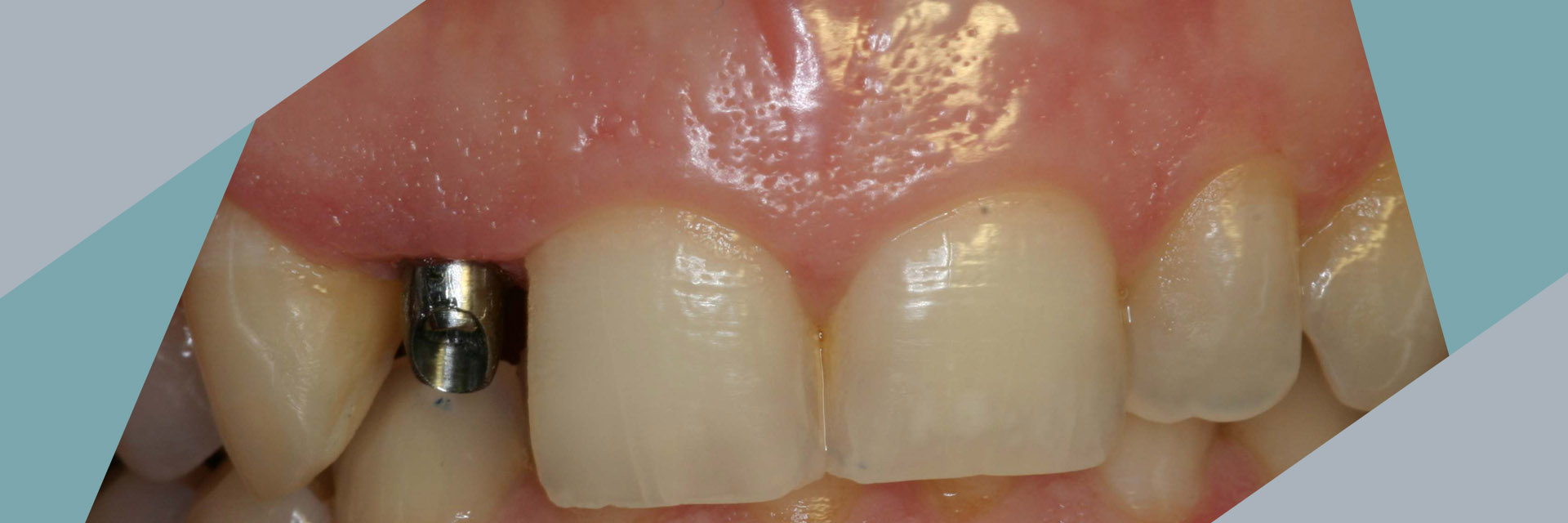 queensboro-dental-implants-flushing-ny-abutment-implant-Slider-01_01