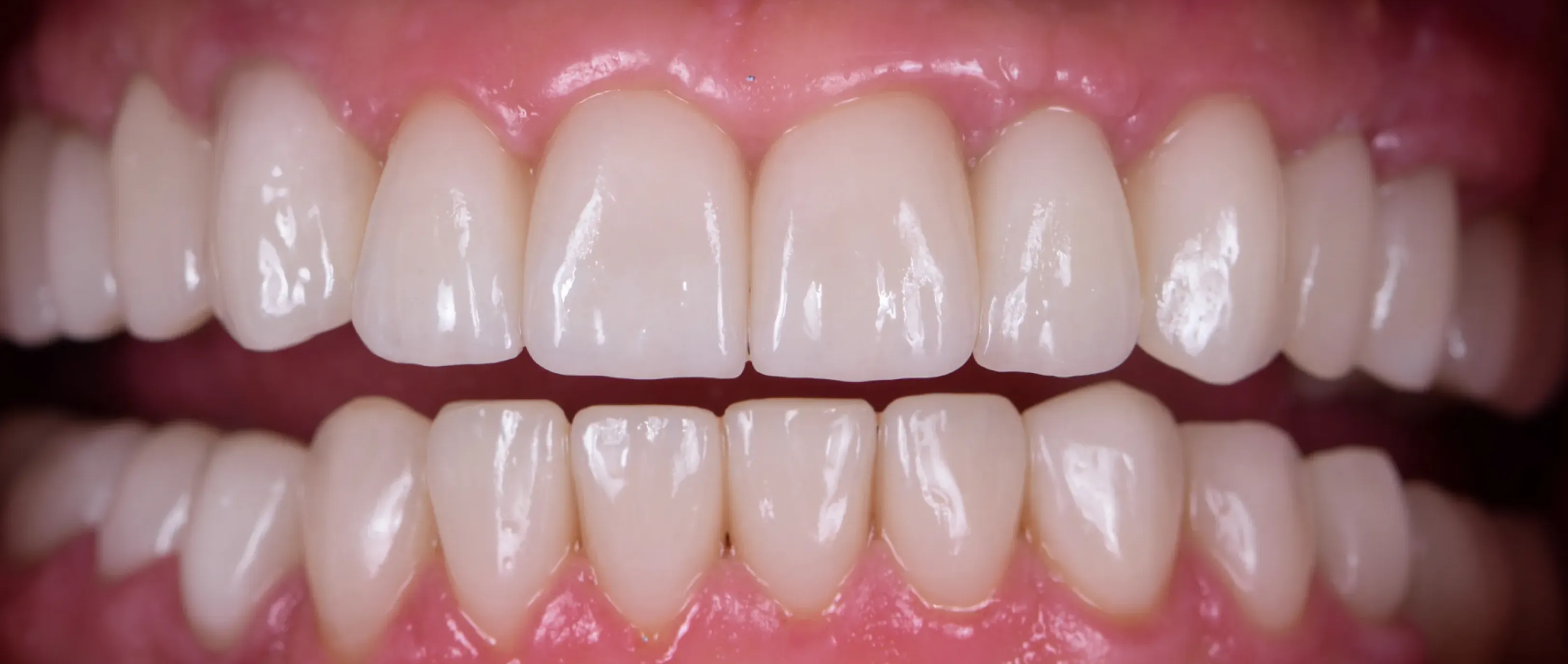 Fully restored and aligned smile after full mouth rehabilitation