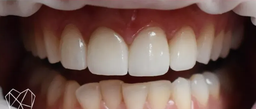 Smooth and natural smile after cosmetic dental restoration