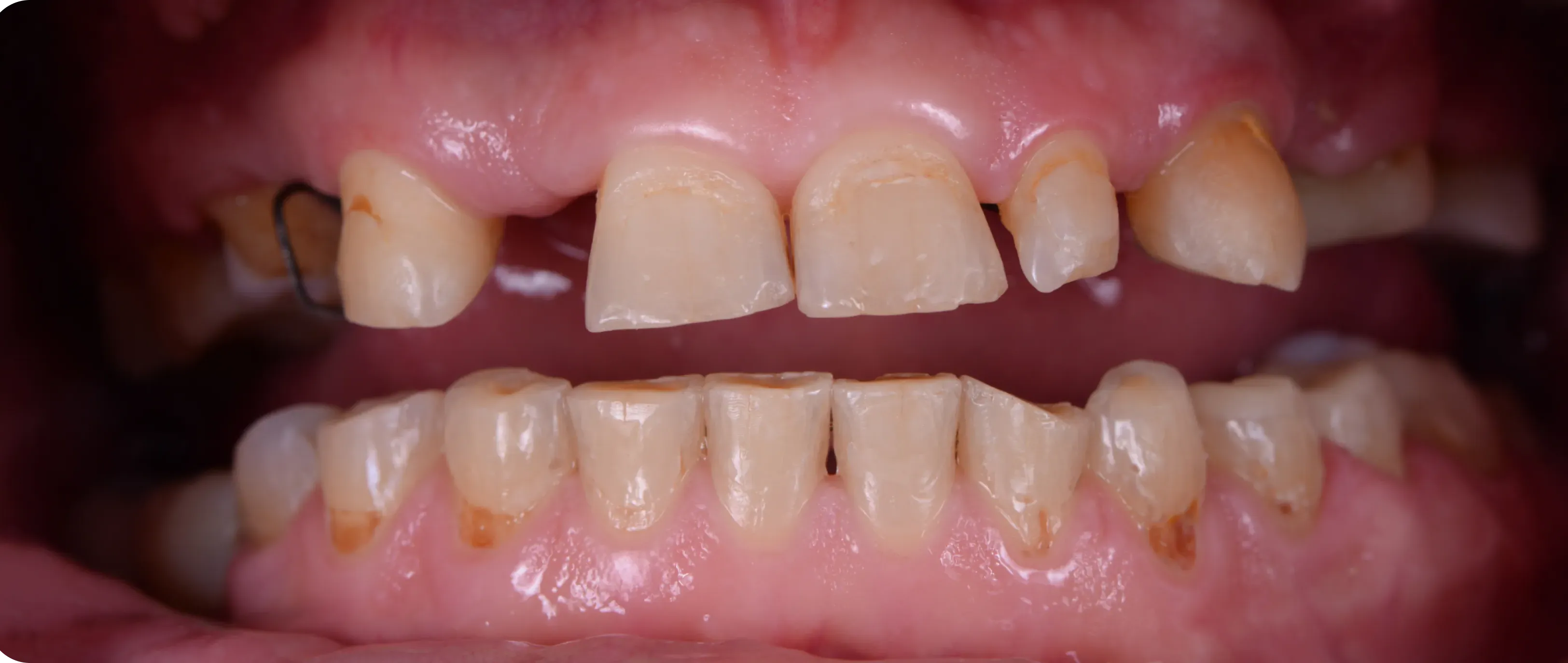 Damaged and misaligned teeth before full mouth restoration