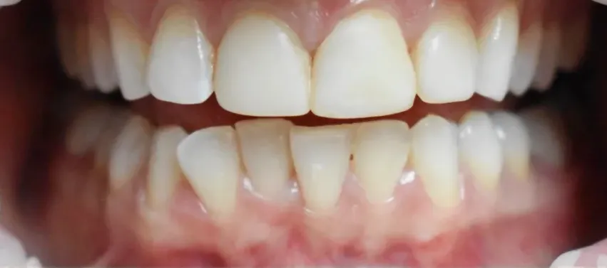 Uneven front teeth before cosmetic dental restoration