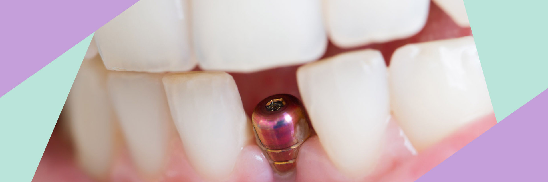queensboro-dental-implants-dental-implant-Slider-01_02