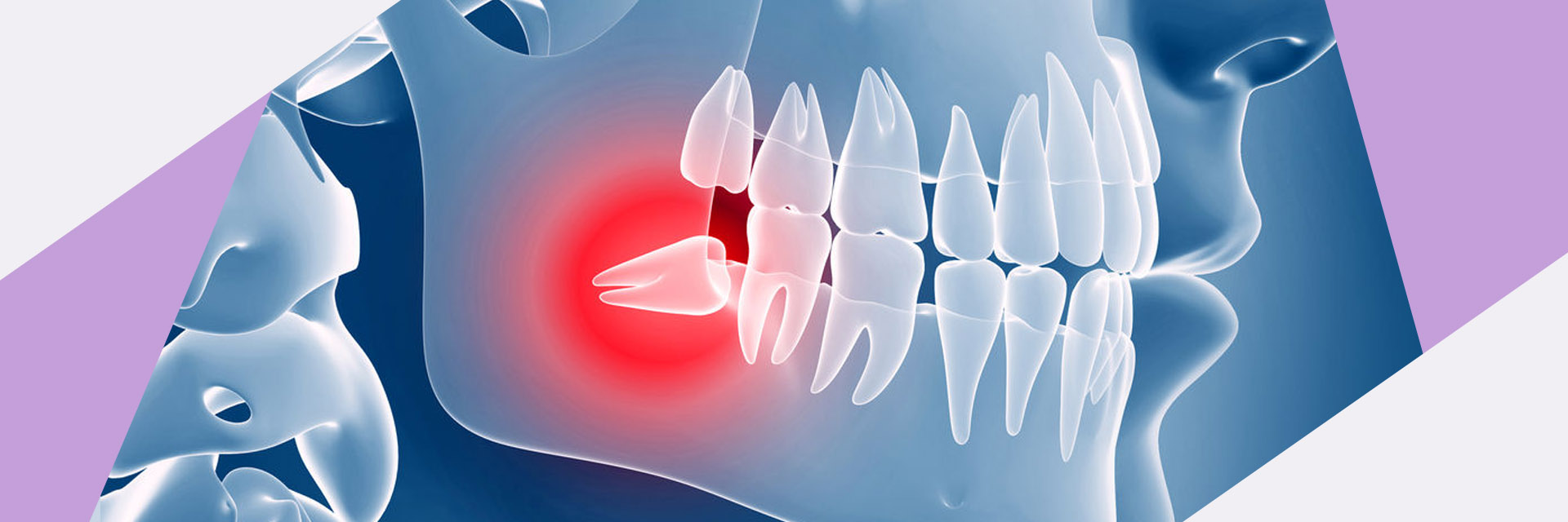 queensboro-dental-implants-flushing-ny-impacted-cuspid-Slider-05