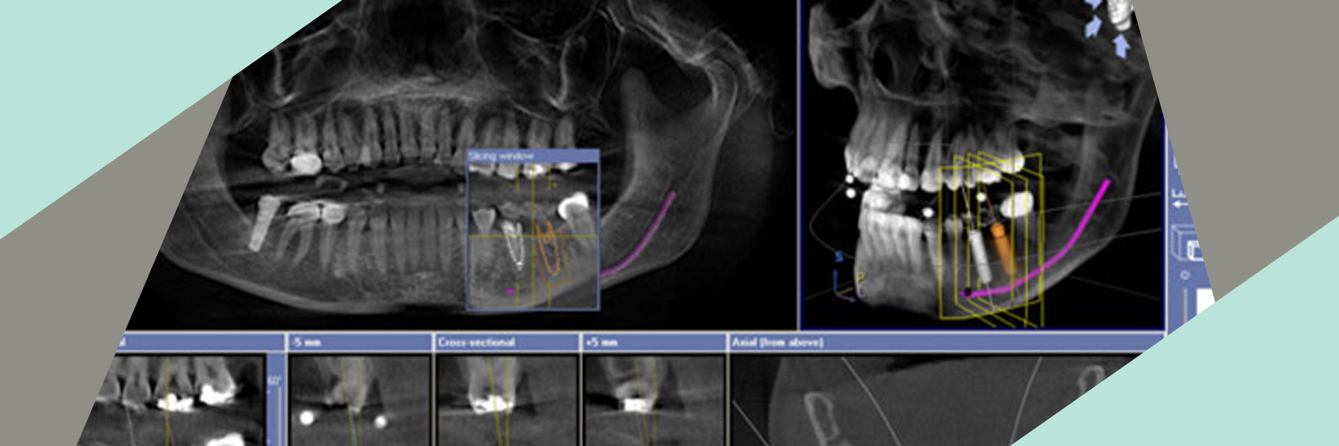 queensboro-dental-implants-flushing-ny-3d-imaging-for-implant-placement-slider-03_03