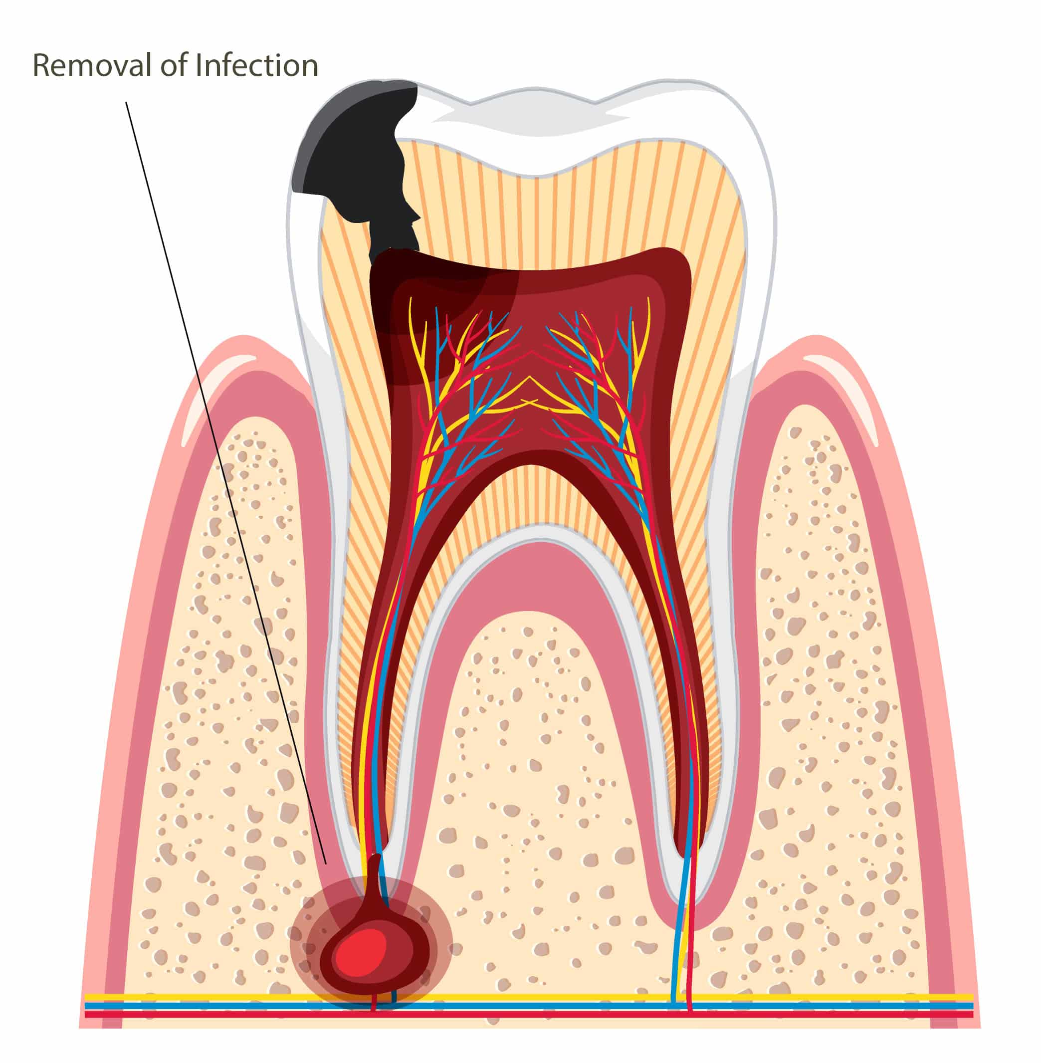 Apicoectomy in Flushing in Fresh Meadows, NY. Dr. Howard Ochs, Dr. Maria Dourmas-Papazahariou, Dr. Vincent Debitetto. Queensboro Oral Surgery Associates