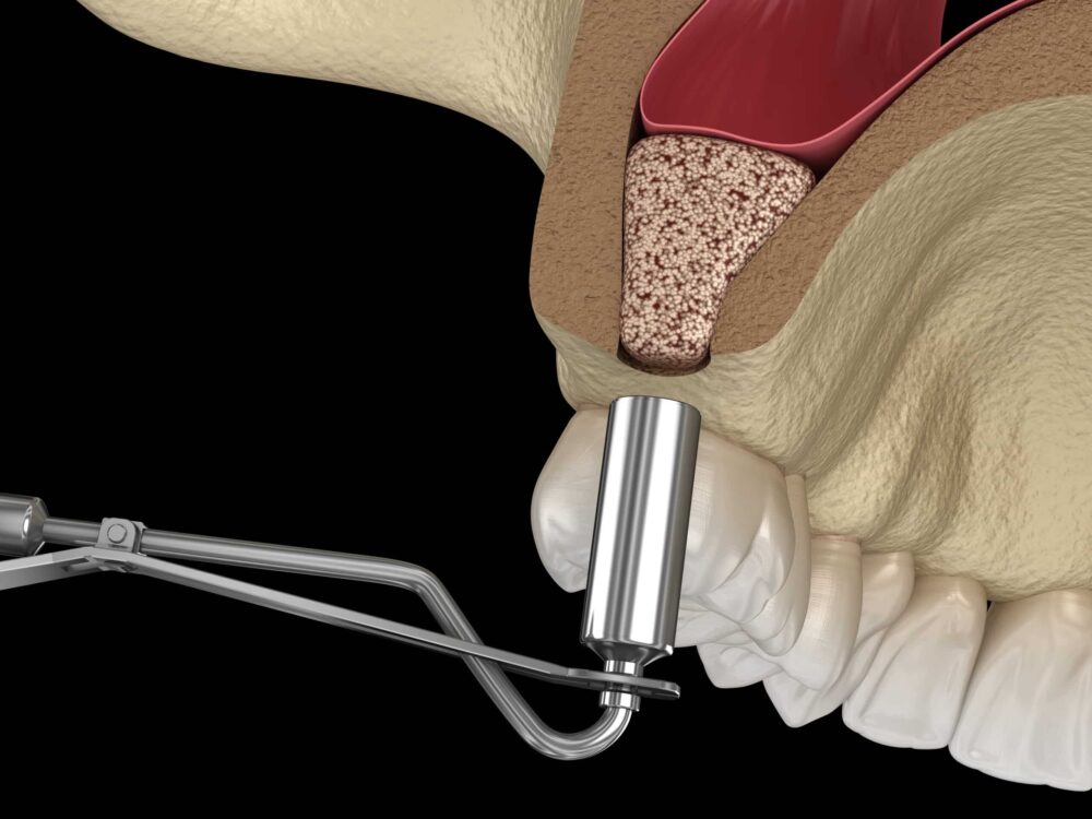 Sinus Lift Fresh Meadows